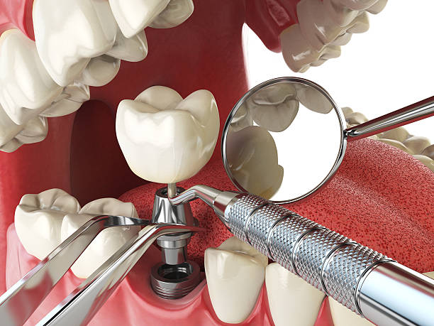 Best Emergency Treatment for Dental Infections or Abscesses in Union Springs, AL